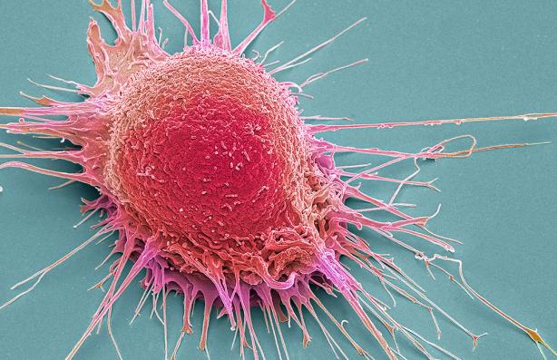 Prostate cancer cell, coloured scanning electron micrograph (SEM)