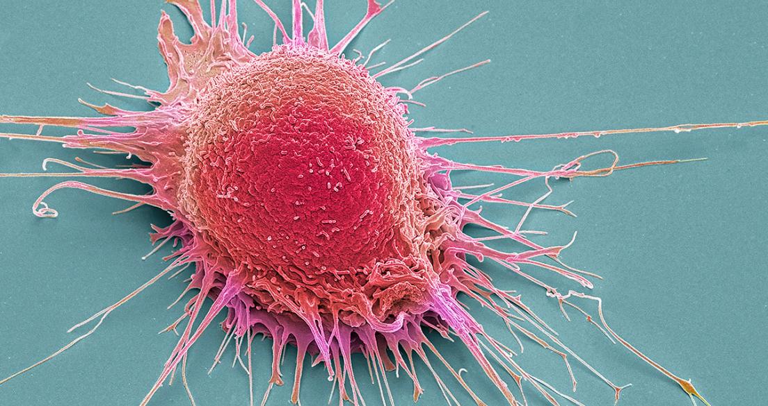 Prostate cancer cell, coloured scanning electron micrograph (SEM)